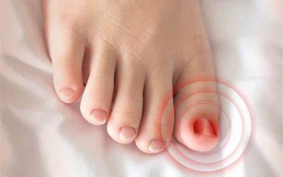 Do I Need Surgery for My Ingrown Toenail?